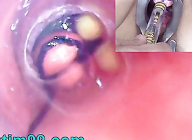 Grown up Woman, Peehole Endoscope Camera in Bladder with Balls